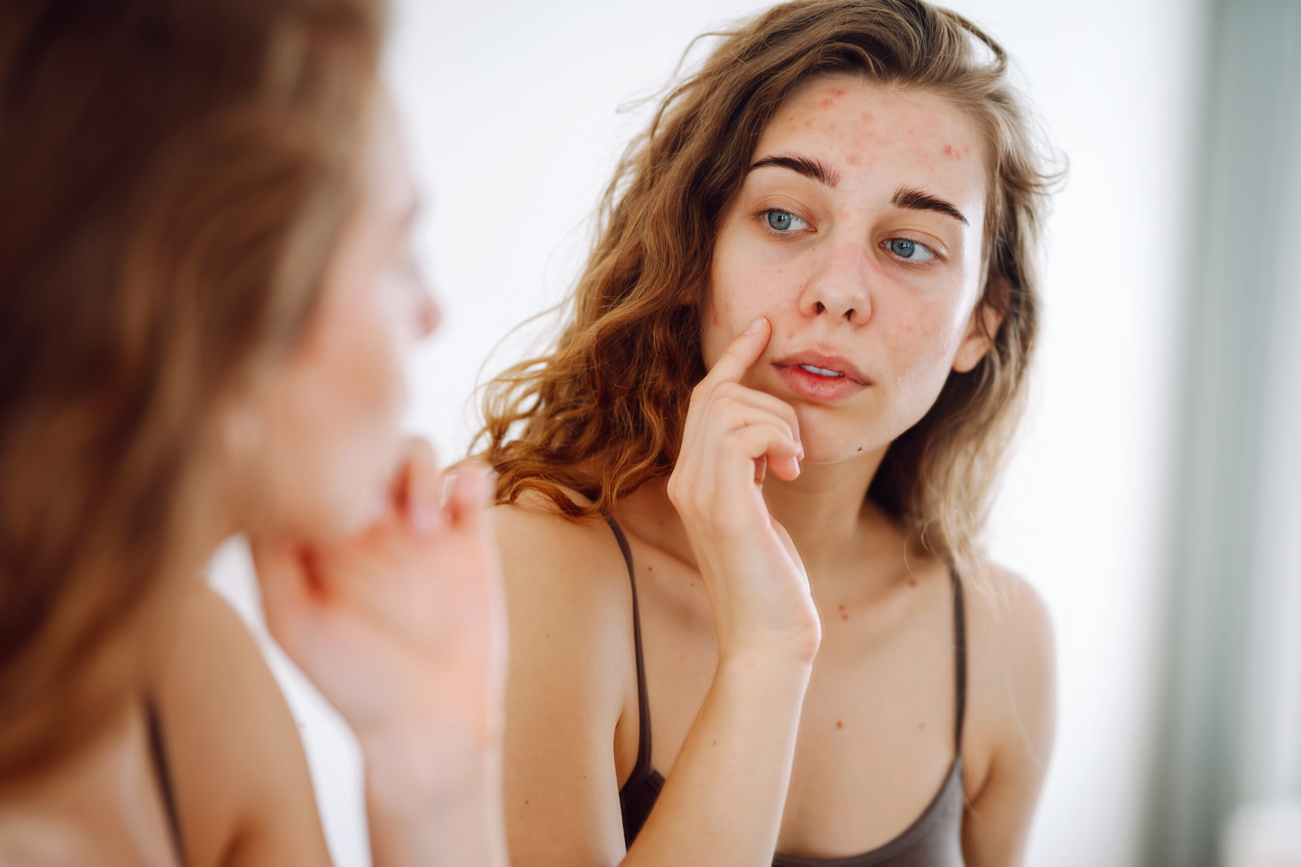 Titelbild zu „Skin Purging oder Problemhaut? So findest Du es heraus“
